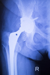 Hip replacement orthopedics implant xray