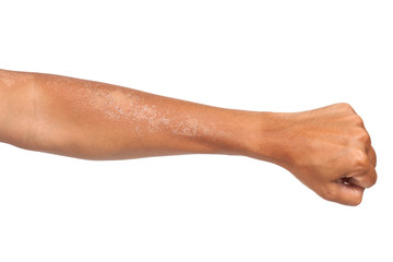 peeling of skin after burned by sunlight