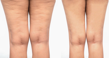 Cellulite  women. Figure of a young girl before and after. - obrazy, fototapety, plakaty