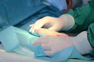 Ein Chirurg führt eine Karpaltunnel-Syndrom-OP durch