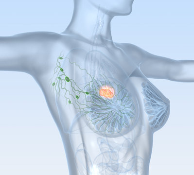 Breast cancer, lymphatics, mastocarcinoma