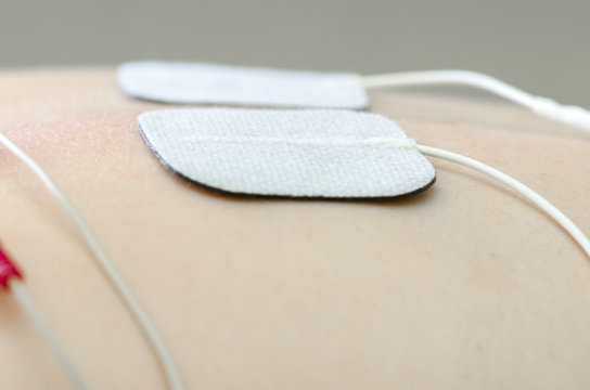 TENS electrodes positioned for back pain treatment in physical t