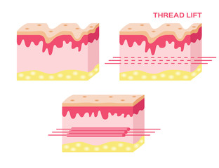 skin vector with step of thread lift , thread lift vector