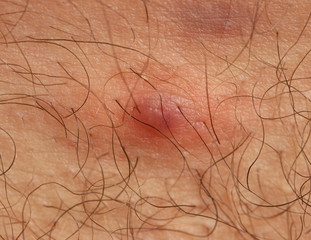 inflamed acne on the skin