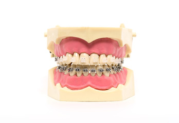 Denture with braces
