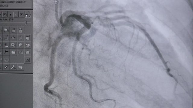 X-ray real heart beating in action on computer screen. HD.