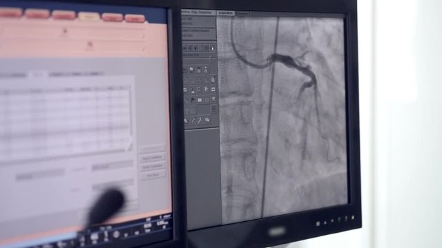 Ultrasound of a Real heartbeat. Ultrasonic examination on computer screen. 1080p.