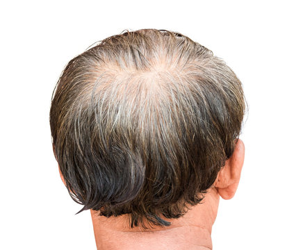 Closeup Old Man Serious Hair Loss And Grey Hair Problem And For Hair Loss Concept