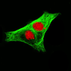 Real fluorescence microscopic view of human neuroblastoma cells