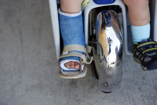 Small child with broken leg in cast