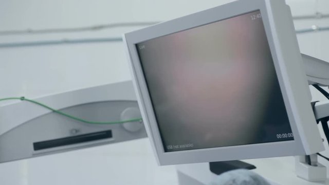 Eye surgery. Cataract removal surgery. Close up 1080p