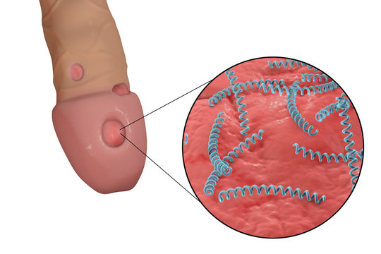 Syphilitic ulcer ulcus durum and close-up view of syphilis bacteria Treponema pallidum on the surface of a penis, 3D illustration