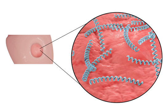 Syphilitic ulcer ulcus durum and close-up view of syphilis bacteria Treponema pallidum on the surface of a penis, 3D illustration