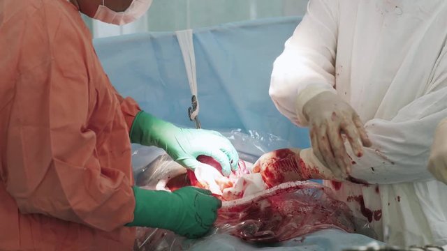 Surgeons sew up stomach of woman by needle and thread. Cesarean section. Patient. Blood. Hospital