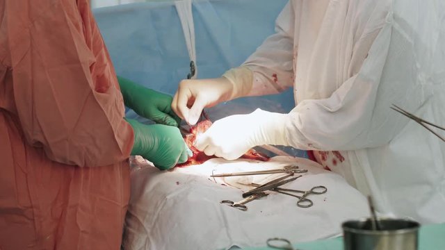 Surgeons sew up stomach of woman by needle and thread after cesarean section. Blood. Hospital