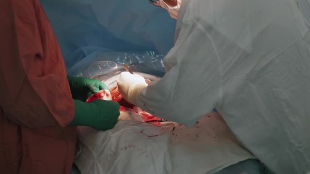 Surgeons sew up stomach of woman after cesarean section by needle and thread. Blood. Hospital