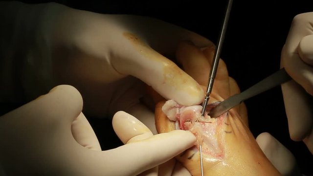 Foot Surgery