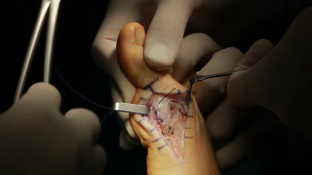 Foot Surgery