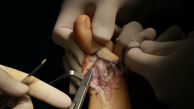 Foot Surgery