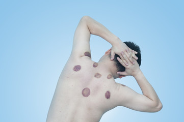 Asian man 43 years old with marking of vacuum cupping, sport the