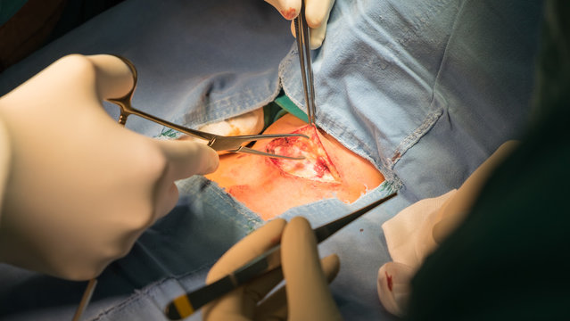 thyroids open surgery in operationroom