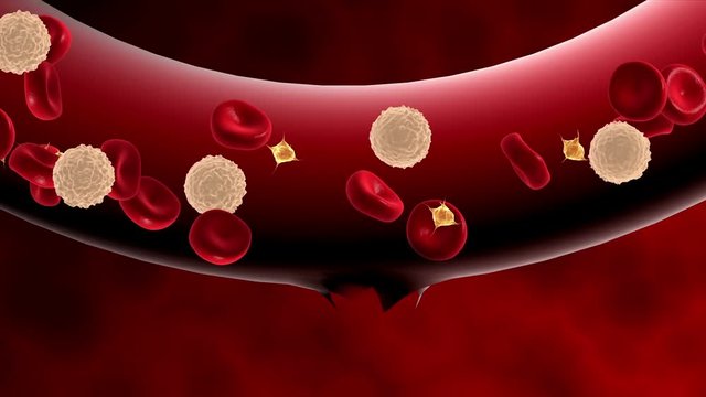 Blood clotting inside artery.
