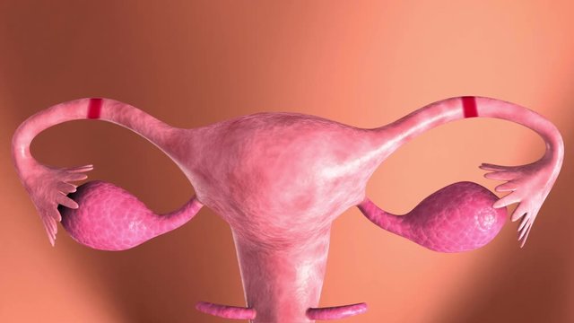 Tubectomy procedure for sterilization of a woman's fallopian tubes.