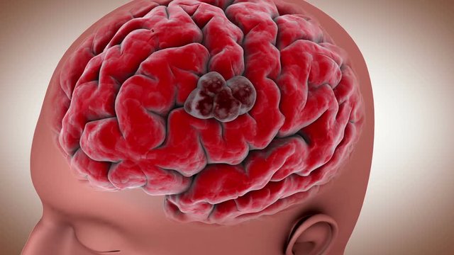 Conceptual video of a tumor in human brain.