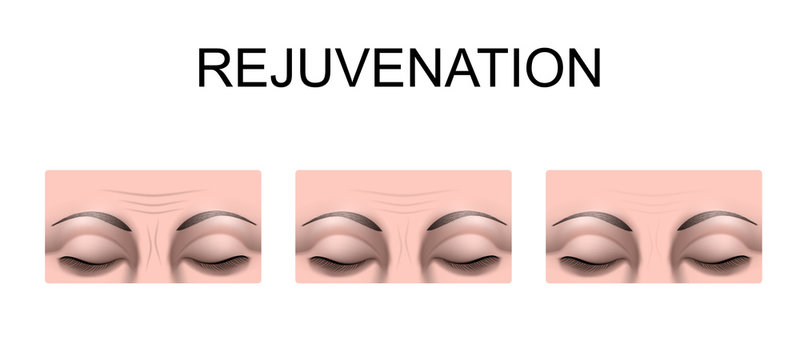 wrinkles on the forehead. rejuvenation. plastic surgery