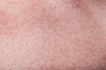 macro of skin with rash
