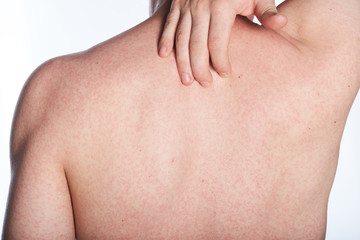 allergy on back of man
