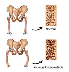  Illustration of the Rickets-osteomalacia