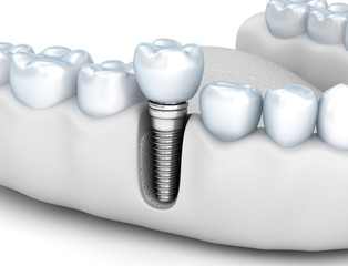 Tooth human implant, Medically accurate 3D illustration white style