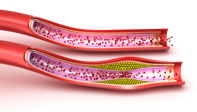 Blood vessel : normal and cholesterol damaged vessel . 3D render