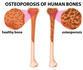 Diagram showing osteoporosis of human bones