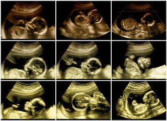 Series of 9 fetal sonograms pictures