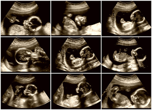 Nine images of fetus ultrasonography
