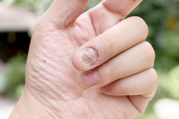 Fungus Infection on Nails Hand, Finger with onychomycosis, A toenail fungus. - soft focus