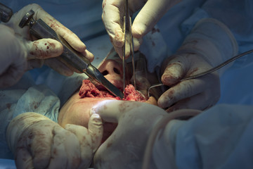 Maxillofacial Surgery Close-Up