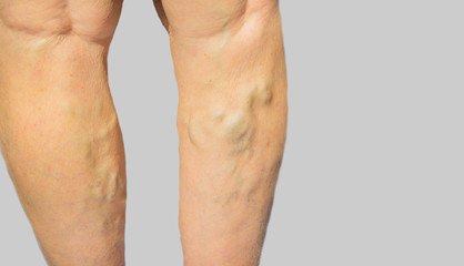 Fototapeta na wymiar Varicose veins on a female legs
