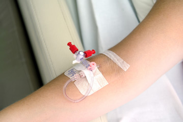 catheter in the arm