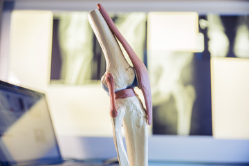 closeup scale model the layout of the artificial knee joint in x-ray leg and knee