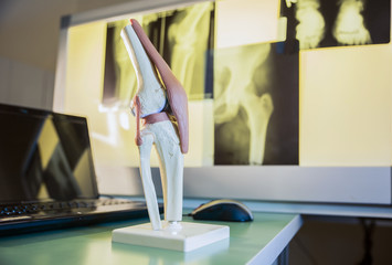 closeup scale model the layout of the artificial knee joint in x-ray leg and knee