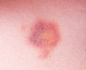 Closeup on a Bruise on wounded