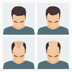 Male hair loss stages set. Male pattern baldness. Different stages of hair loss in man. Transplantation of hair. Human hair growth. Hair care concept. Vector illustration.