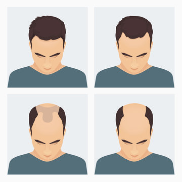 Male hair loss stages set. Male pattern baldness. Different stages of hair loss in man. Transplantation of hair. Human hair growth. Hair care concept. Vector illustration.