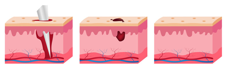 wound skin vector graphic . blood come out of wound