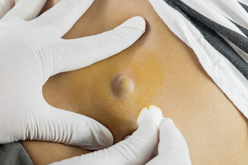 Doctor Diagnosis of the Sebaceous on Woman's Back - obrazy, fototapety, plakaty