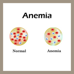 Anemia. The reduced amount of red blood cells. Infographics. Vector illustration