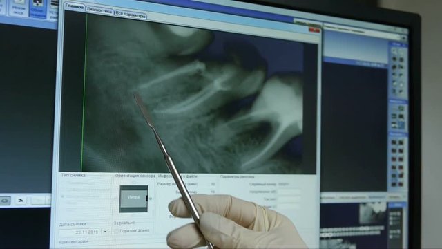 Dentist shows the X-ray image on the monitor of the tooth of the patient
